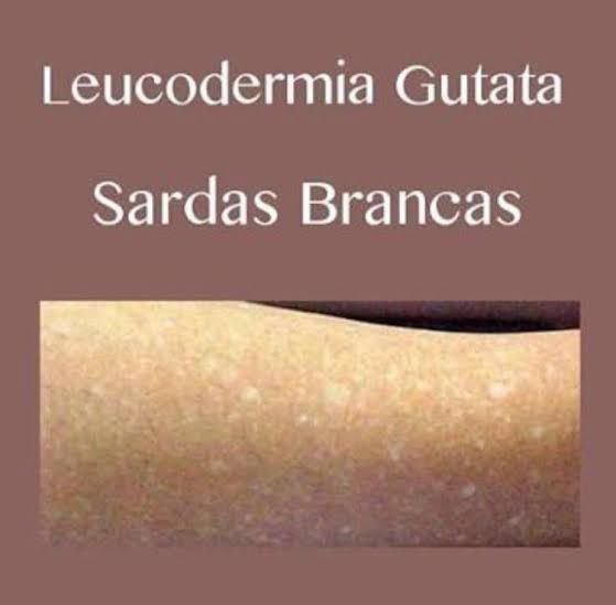 Leucodermia Gutata (Manchas brancas na pele)